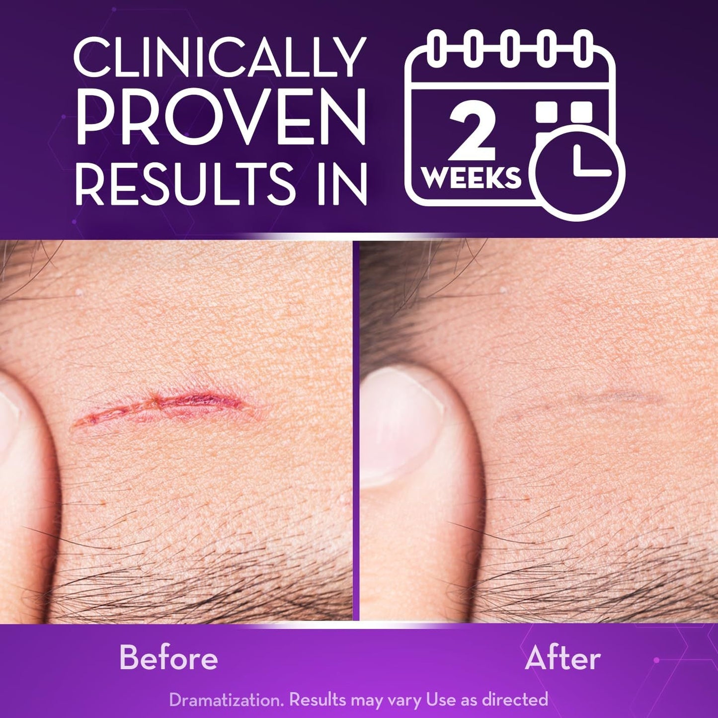Misspone® Scar Gel – Australian Dermatology Approved for Proven Scar Repair Visible Results, Healthier Skin, Renewed Confidence